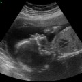 Baby Ultrasound Image