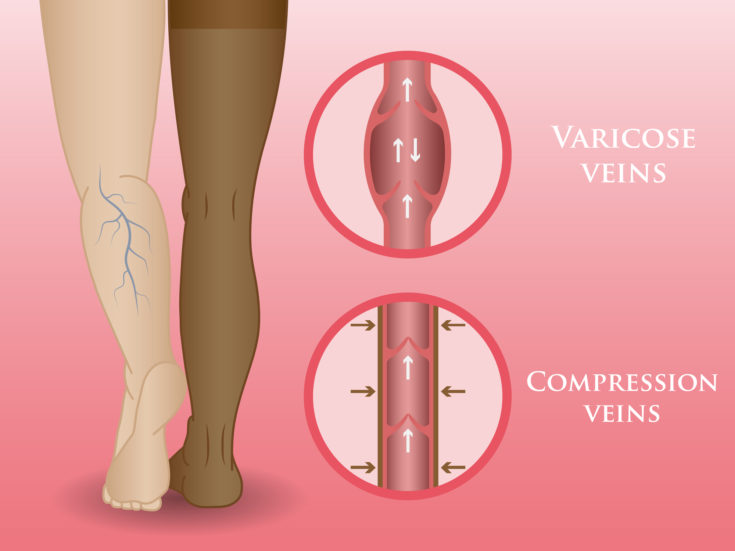 Compression Stockings