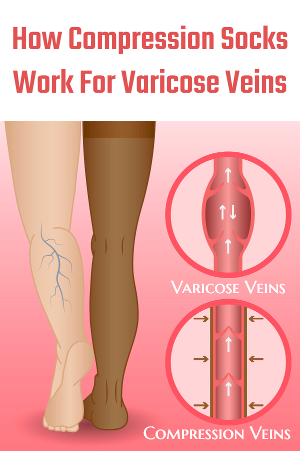 How Compression Socks Work For Varicose Veins