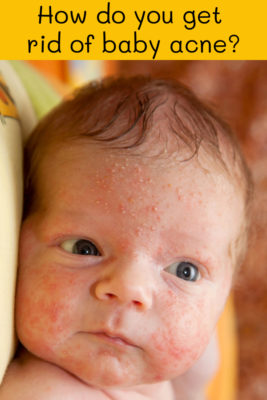 How do you get rid of baby acne?