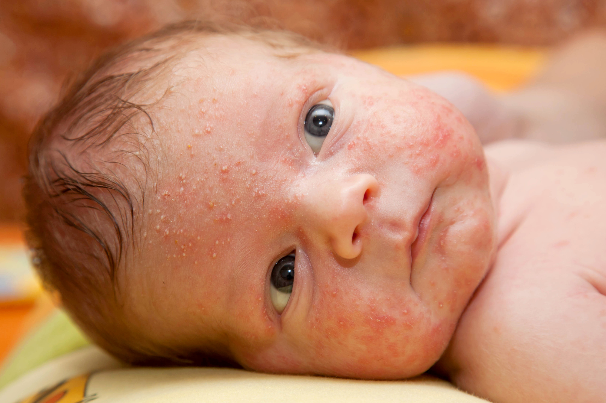 why-do-babies-get-baby-acne-preemie-twins-baby-blog