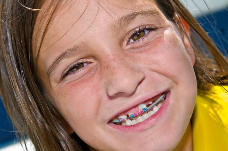 How Braces Can Give Your Kids Better Overall Dental Health